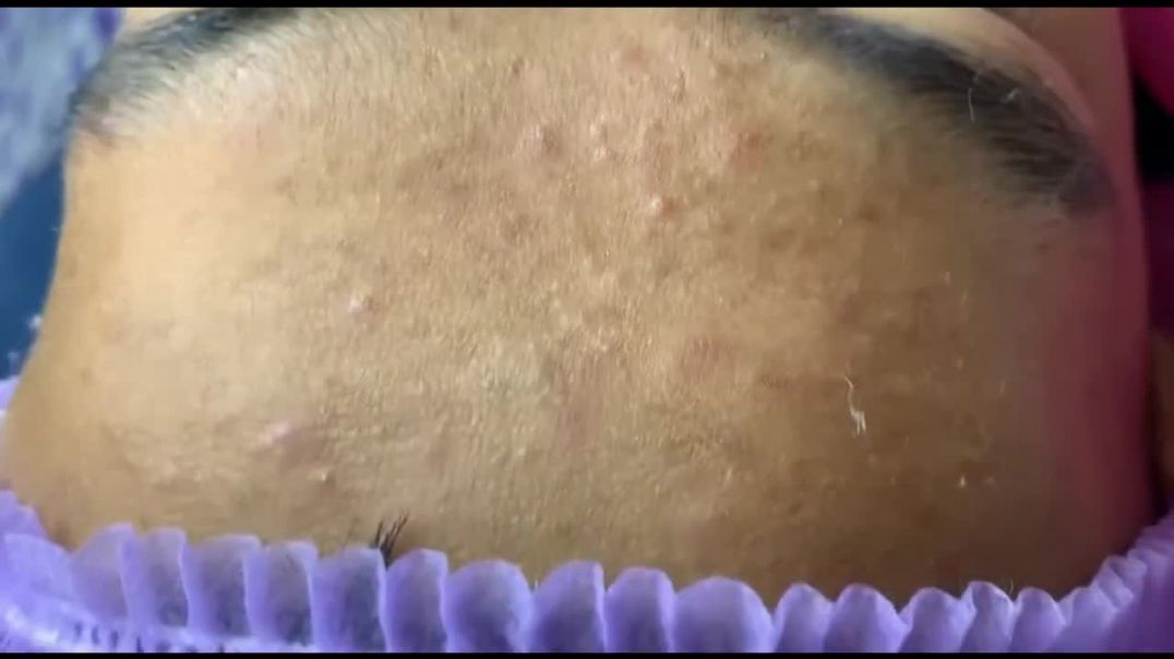 Best Blackhead Removal - Facial Treatment