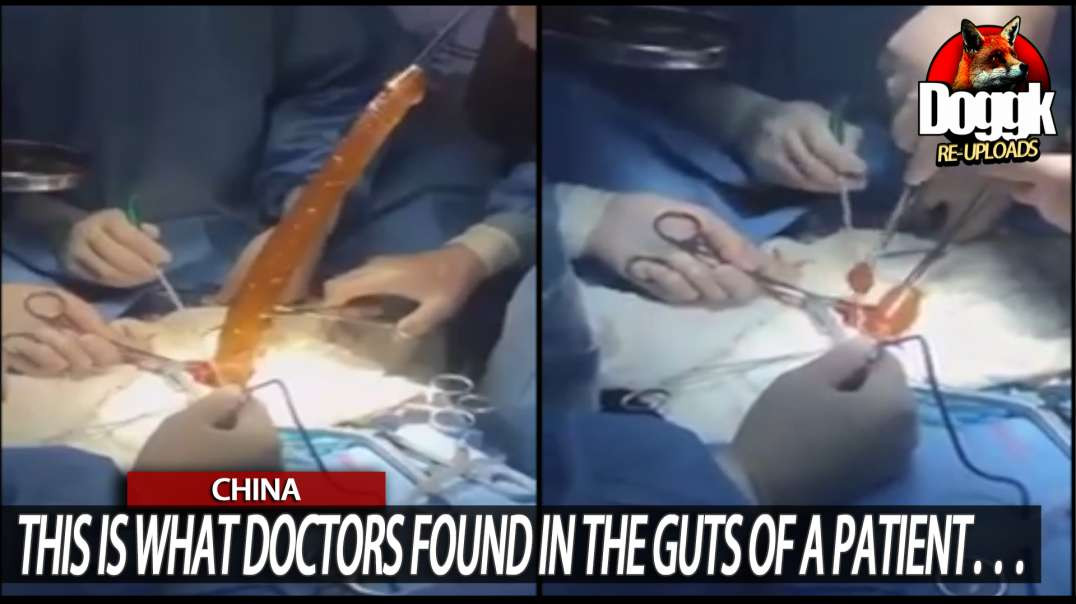 THIS IS WHAT DOCTORS FOUND IN THE GUTS OF A PATIENT... (CHINA)