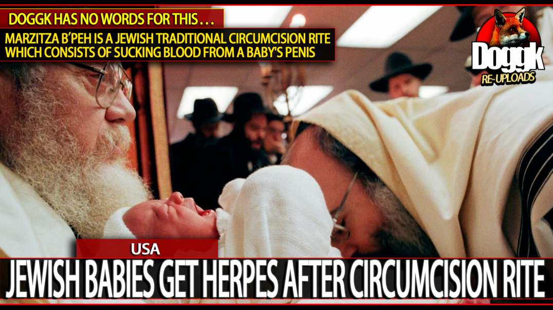 JEWISH BABIES GET HERPES after WEIRD TRADITIONAL CIRCUMCISION RITE.. (USA)