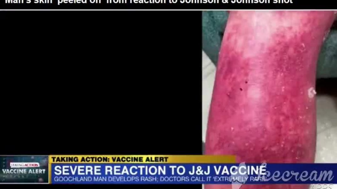 Man's skin peeled off after JJ Vaccine