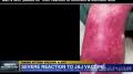Man's skin peeled off after JJ Vaccine