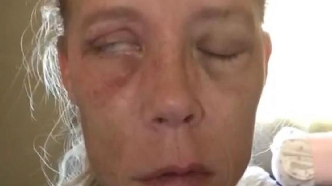 46-YEAR OLD CANADIAN WOMAN ‘CARRIE SAKAMOTO’ WAS INJURED BY THE COVID-19 VACCINE