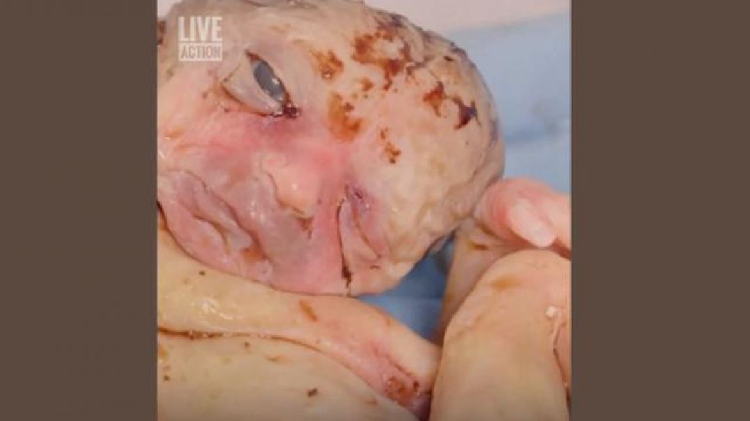 This is the graphic footage of what happens to babies at an abortion clinic.