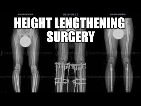 Height Lengthening Surgery