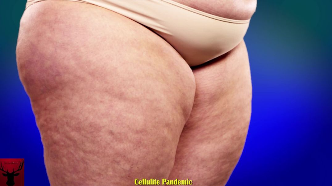 Cellulite Pandemic