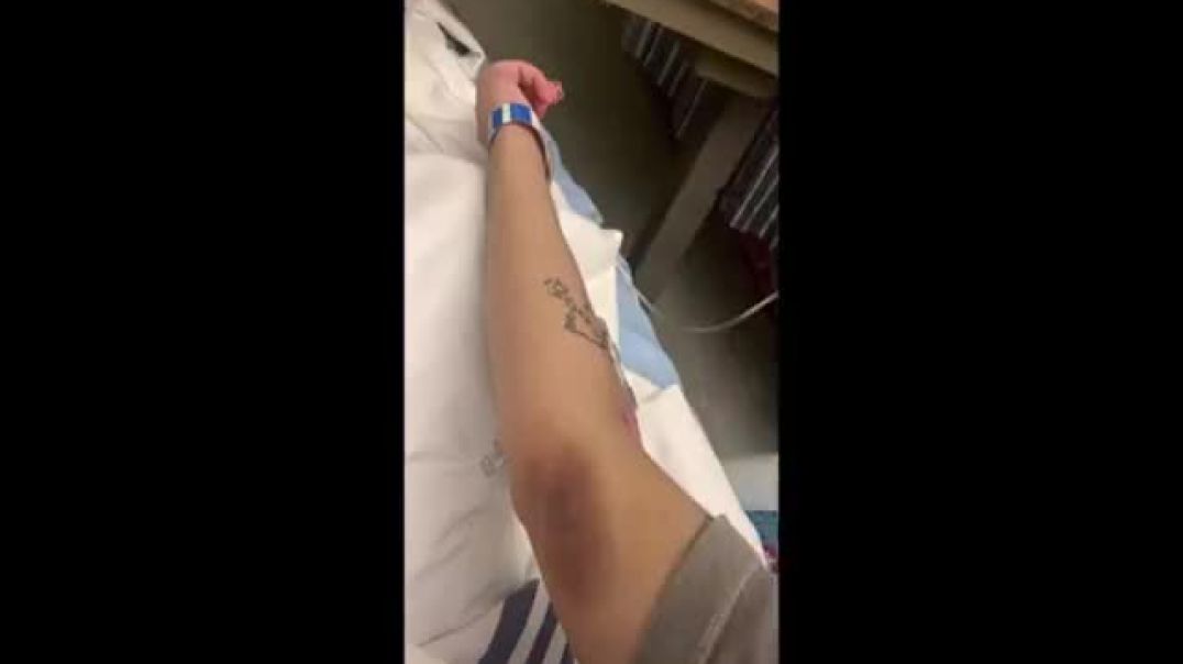 DISTURBING BLOOD BLISTERS AND BLACK URINE AFTER 2 PFIZER COVID SHOTS - ALL 5 VIDEOS COMBINED