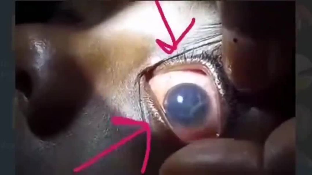 FREAK OUT ALERT - DR. RECORDS HYDRA VULGARIS SWIMMING IN THE EYE OF AN 11YR OLD VAXXED PATIENT