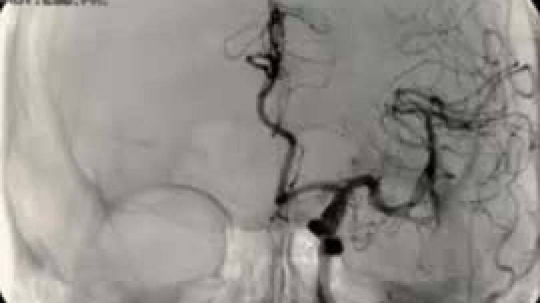 MULTIPLE BRAIN ANEURYSMS - GIVEN A 3-6 MONTH LIFE EXPECTANCY - FULLY VACCINATED (JAN. 2023)