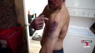 Flesh Eating Bacteria Australia Increases