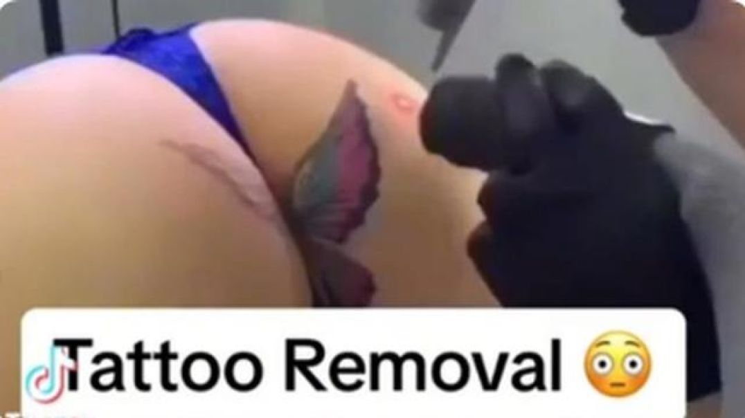 FROM THE HOLY CRAP DEPARTMENT - LASER BUTT CRACK TATTOO REMOVAL - OUCH!? (MY THOUGHTS IN THE DESC.)