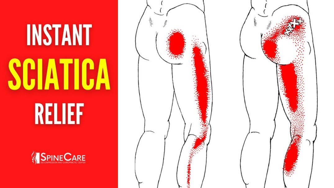 How to Instantly Fix Sciatica Pain