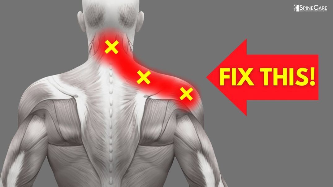 How to INSTANTLY Fix Pinched Nerve Pain in the Neck and Shoulders