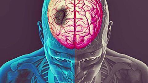 CVC (Corrupção Vascular Cerebral) diagnóstico, sintomas e tratamento!