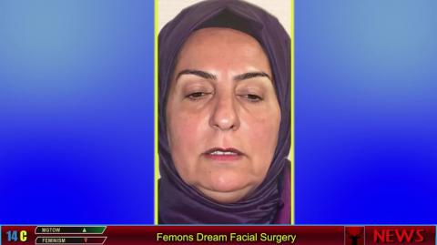 Femons Dream Facial Surgery