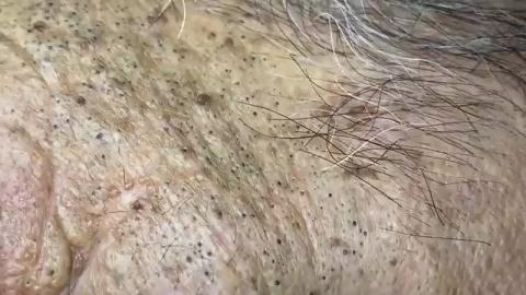 Pimple and Black Head Squeezing - Delicious and Finger Licking Good.