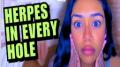 I Have HERPES in 3 Holes D: