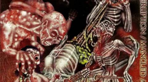 Artery Eruption - Ultimately Uterectomized