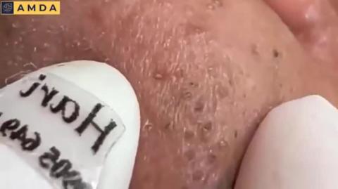 Face Clean - Pimples, Acne, Black Heads