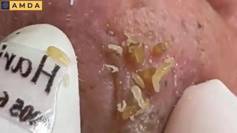 Face Clean - Pimples, Acne, Black Heads