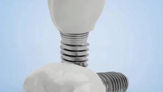 Do Dental Implants Trigger Alarms through Airport Security? | Triveni Dental | Dr. Kapil Sharma