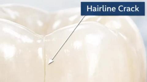 Tooth Pain Due to Crack? Treatment explained | Cracked Tooth Syndrome | Triveni Dental