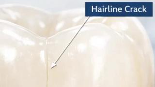 Tooth Pain Due to Crack? Treatment explained | Cracked Tooth Syndrome | Triveni Dental