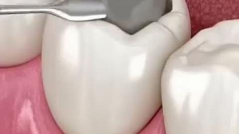 Can a cavity be reversed without getting a dental filling? | Triveni Dental