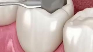 Can a cavity be reversed without getting a dental filling? | Triveni Dental