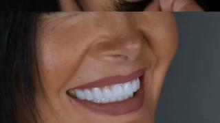 Teeth Cleaning Mein Exactly Kya Hota Hai? | Triveni Dental